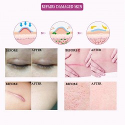 Remoção de cicatrizes e tratamento de acne - óleo de massagem lavanda 10 ml