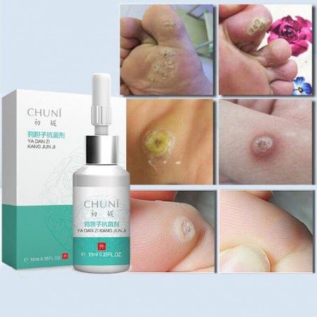 Líquido para remover etiquetas de pele - toupeiras - verrugas - clareamento sardas - 10ml