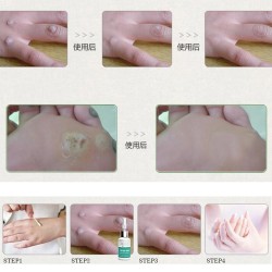 Líquido para remover etiquetas de pele - toupeiras - verrugas - clareamento sardas - 10ml