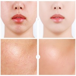 Hyaluronic acid face serum - moisturizing - shrink pores - acne marks removal - nourishingSkin