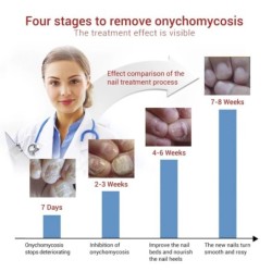 Gel removedor de fungos nas unhas - soro - anti-infecção / paroníquia / onicomicose - 10ml