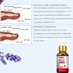 Toenail fungus removal gel - serum - anti infection / paronychia / onychomycosis - 10mlTreatment