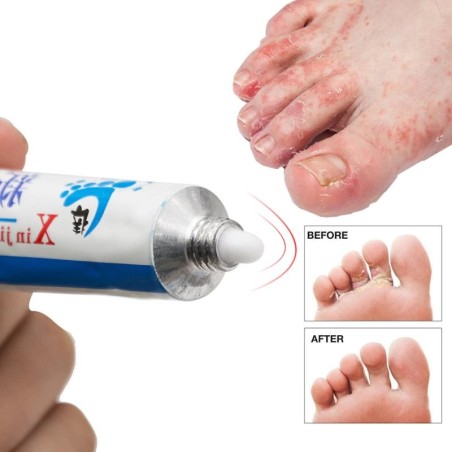 Pomada antibacteriana para os pés - anti-coceira - remoção de calos - anti-suor - anti-odor - psoríase