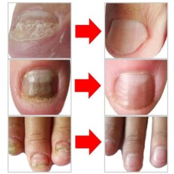 Onychomycosis removal oil - essence liquid serumTreatment