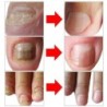 Onychomycosis removal oil - essence liquid serumTreatment
