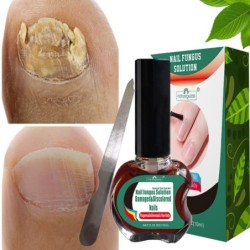 Onychomycosis removal oil - essence liquid serumTreatment
