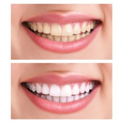 Prótese cosmética de silicone - aparelho superior/inferior