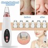 Removedor de cravos / acne - limpador de poros faciais - cuidados com o rosto por sucção a vácuo - USB