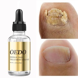 Tratamento de fungos nas unhas - óleo essencial