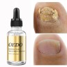 Tratamento de fungos nas unhas - óleo essencial