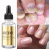 Tratamento de fungos nas unhas - óleo essencial