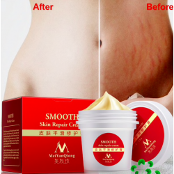 Marcas de estiramento e cicatrizes remoção creme de corpo de reparação