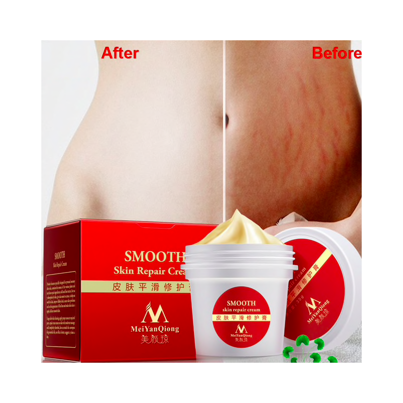 Marcas de estiramento e cicatrizes remoção creme de corpo de reparação