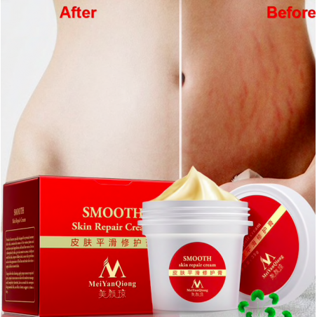Marcas de estiramento e cicatrizes remoção creme de corpo de reparação