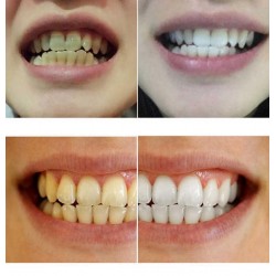 Água de branqueamento de dentes 10 ml