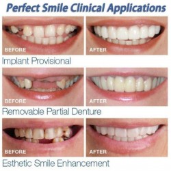 Tampa de dentes de silicone - prótese 2 peças